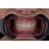 Cheek Retractor Black Double Ended                  